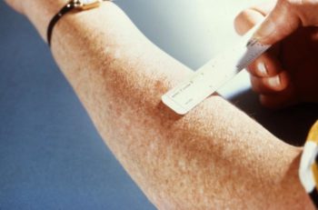An arm with a TB test