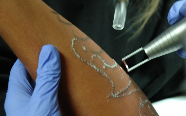 Laser Tattoo Removal in San Diego, CA | South Coast MedSpa