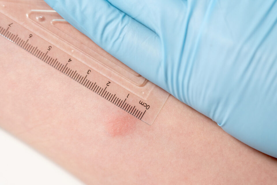 Measurement of tuberculosis test on an arm