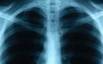 chest x-ray